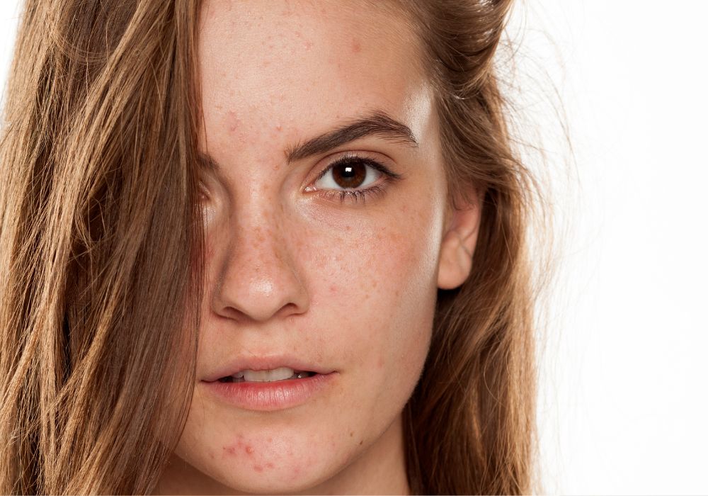 Ácido Tranexâmico Como Funciona no Clareamento de Melasma e Manchas de Pele