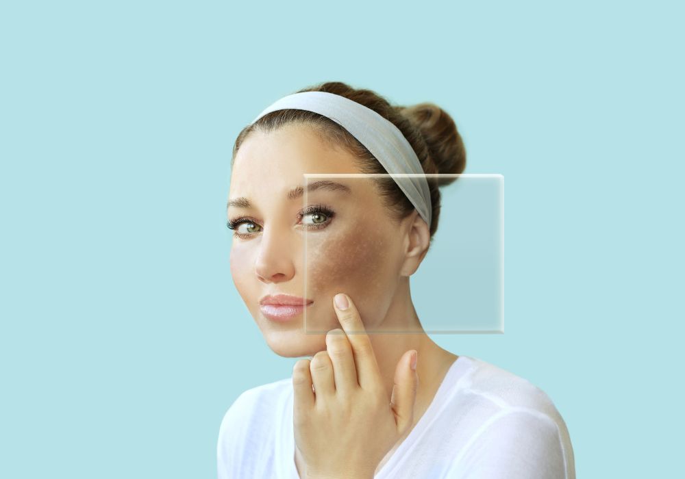 Melhor Clareador de Melasma Guia Completo para Escolher o Produto Ideal