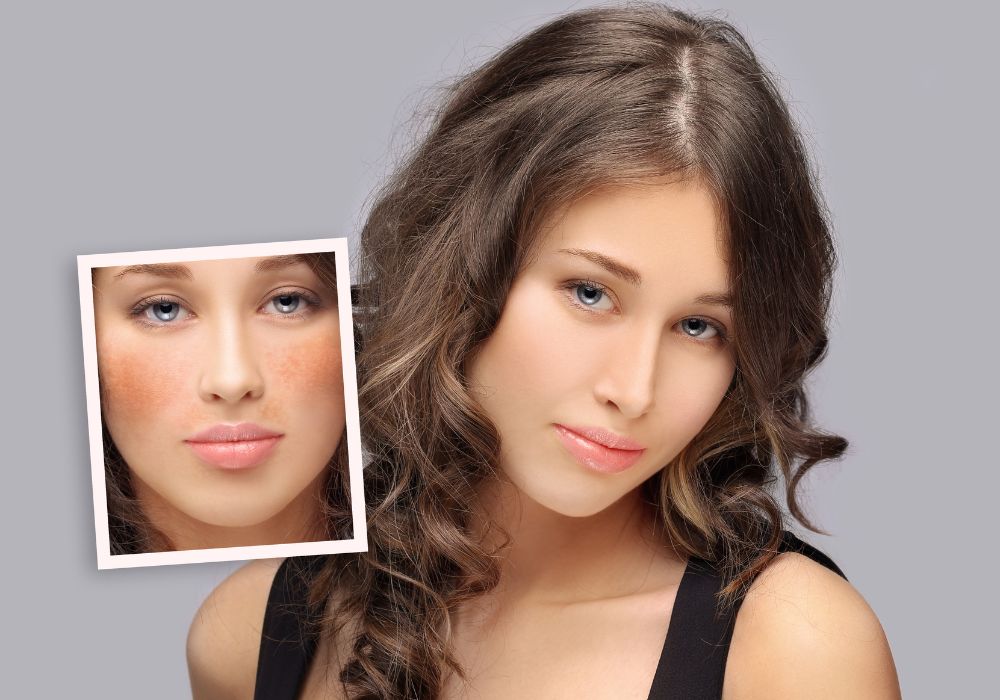 Melhor Despigmentante para Melasma Tratamentos, Produtos e Dicas
