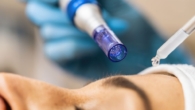 Microagulhamento com Drug Delivery - O que é e Como Funciona