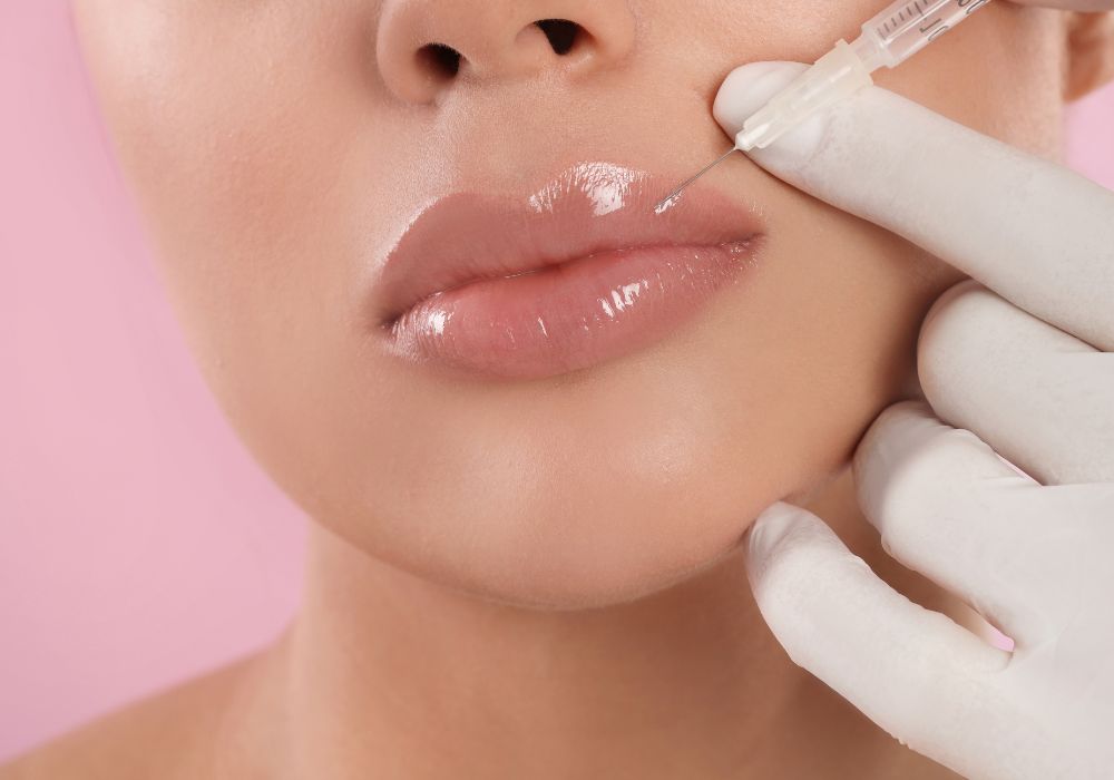 Preenchimento Labial com Acido Hialurônico Lábios mais Bonitos