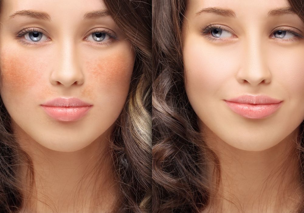 Qual o Melhor Tratamento Estético para Manchas Faciais