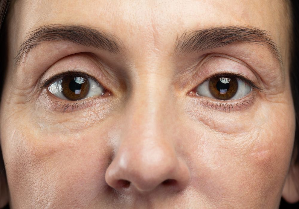 Procedimentos estéticos para reduzir bolsas nos olhos