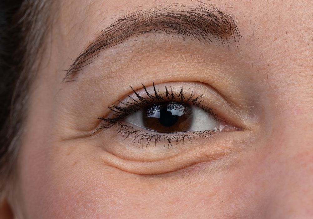 Quais os Melhores Procedimentos para Reduzir Bolsas nos Olhos