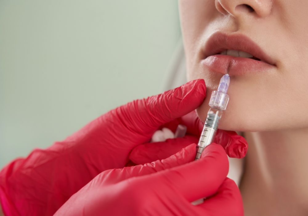 O que é preenchimento labial, como é feito e para quem é indicado