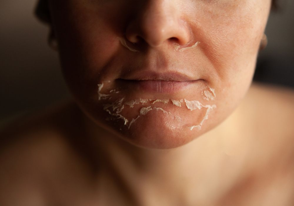Qual o Melhor Peeling para Manchas Descubra o Segredo da Pele Uniforme