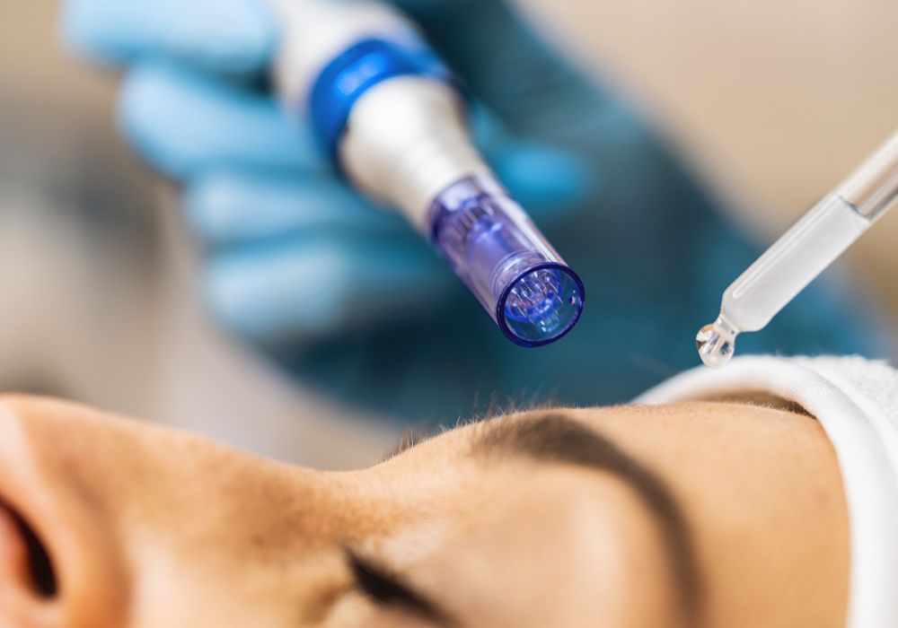 Microagulhamento com Drug Delivery - O que é e Como Funciona