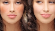 Qual o Melhor Tratamento Estético para Manchas Faciais