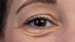 Quais os Melhores Procedimentos para Reduzir Bolsas nos Olhos
